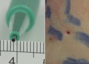 1 mm punch biopsy