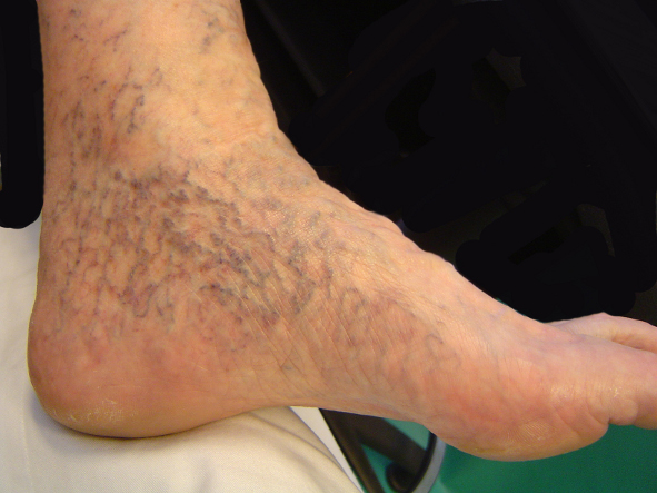 ankle ulcers #11