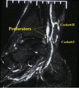 Calf perforating veins