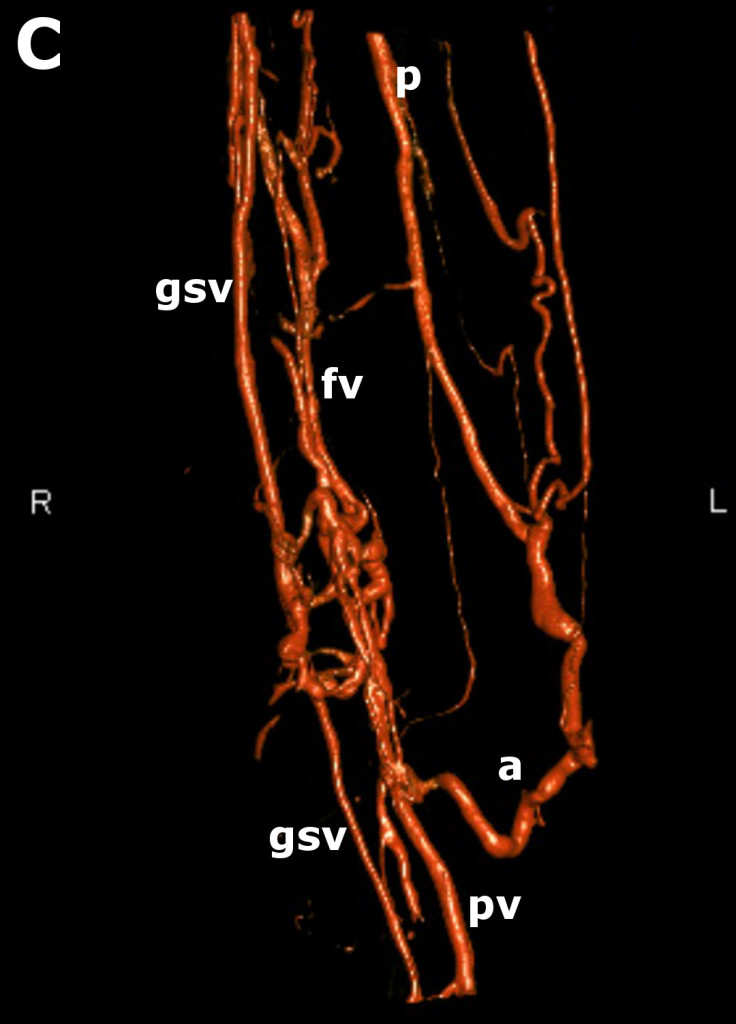 Scarring Post Dvt Josef Pflug Vascular Laboratory