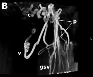 Femoral Vein Occlusion