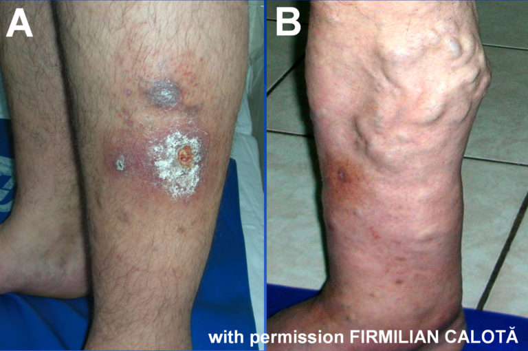 Pathogenesis Of The Venous Ulcer Josef Pflug Vascular Laboratory