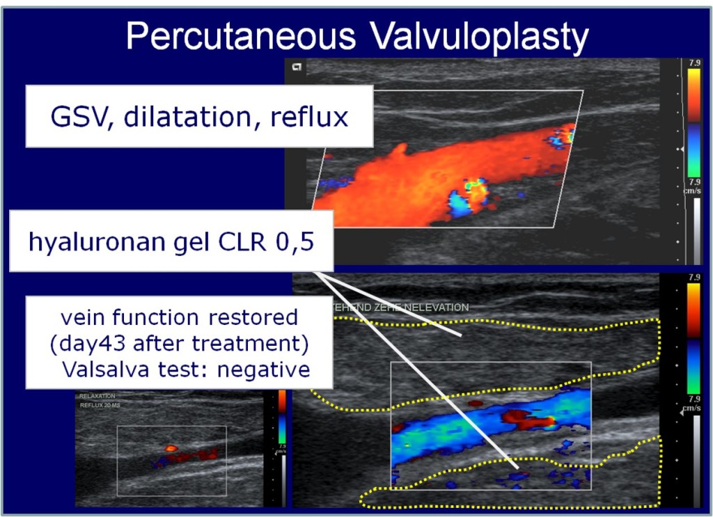 Percutaneous Valvuloplasty JOSEF PFLUG VASCULAR LABORATORY